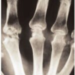 Reumatoïde artritis